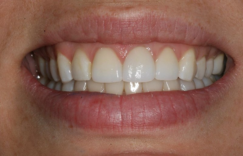 healthy gums