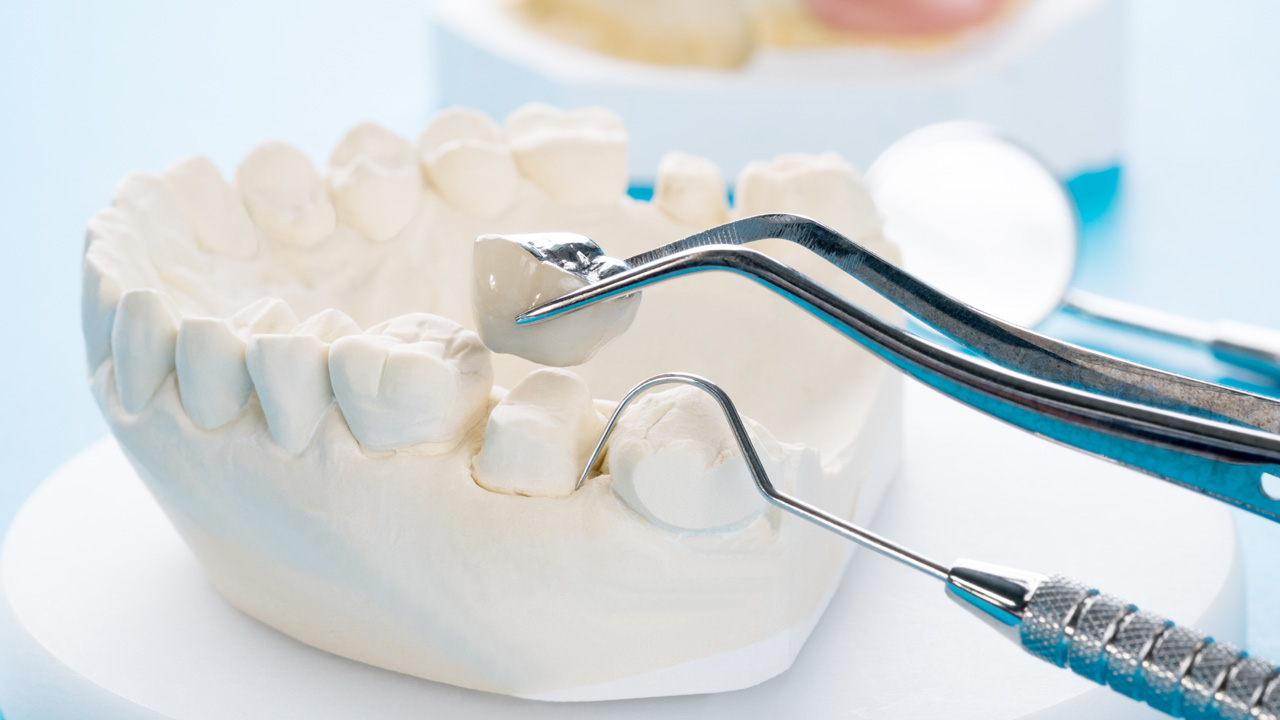 What to Expect During Dental Crown Placement