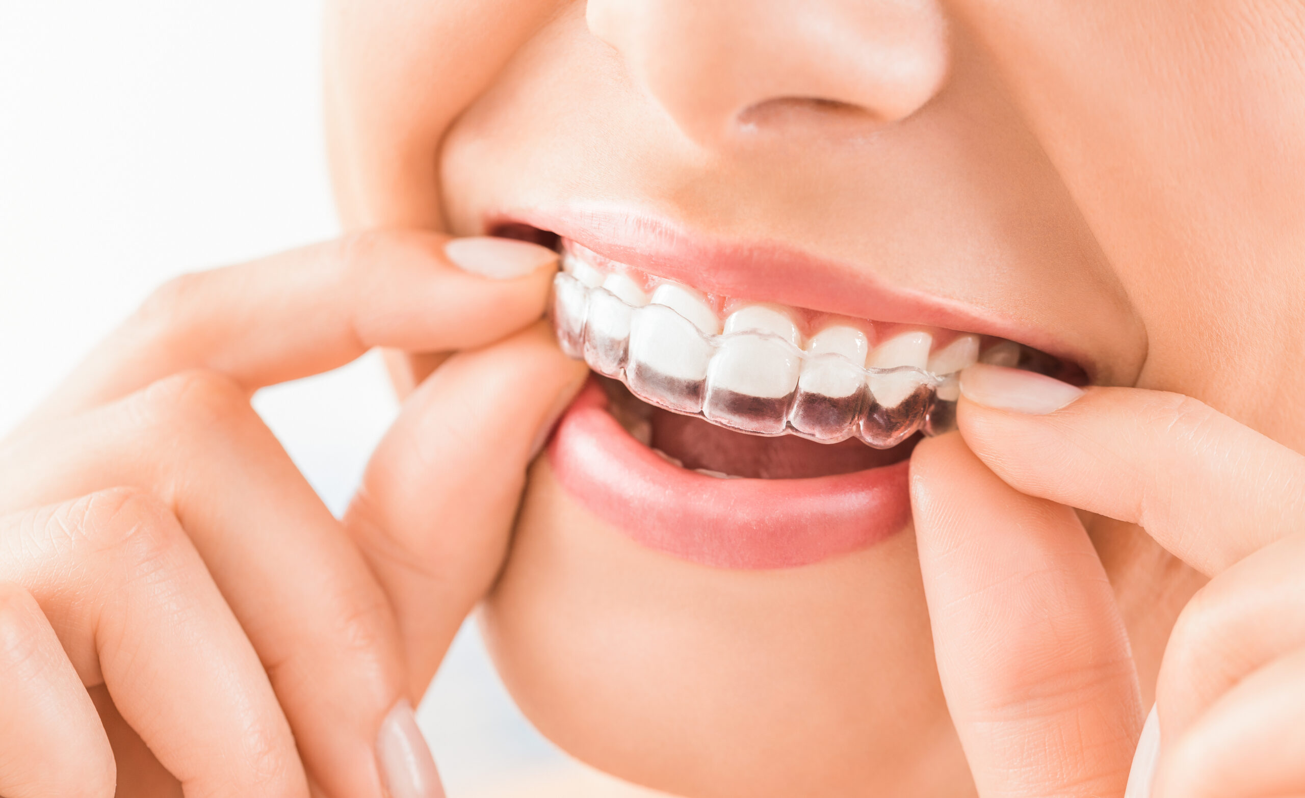 Why January Is the Perfect Time for Invisalign: Start Your New Year with a Confident Smile